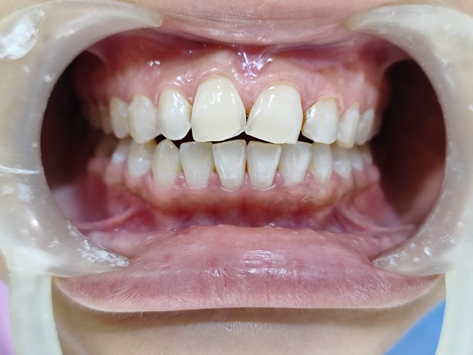 After - Teeth Whitening