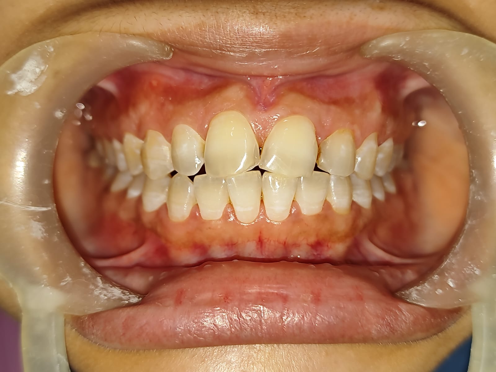 Before - Teeth Whitening